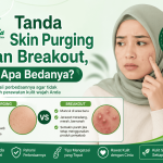Tanda Skin Purging dan Breakout